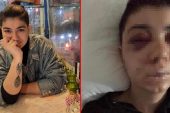 Beyoğlu’nda genç bayanı felç eden dayak! Bir kelam etti, tanınmaz hale geldi