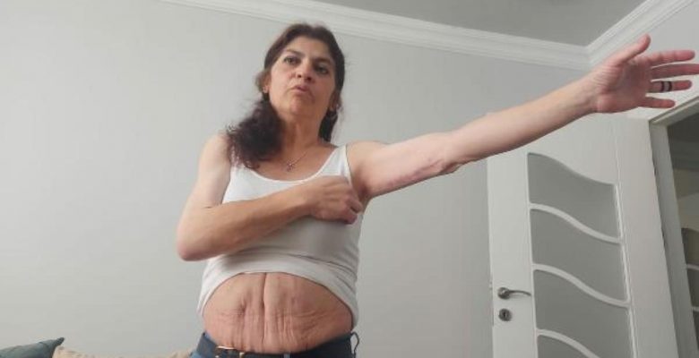 3 AMELİYAT GEÇİRDİ, ESTETİK OPERASYONLAR SONRASI HAYATI KABUSA DÖNDÜ