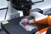 SMA nedir? SMA taraması zarurî mu oldu? SMA tedavisi var mı?